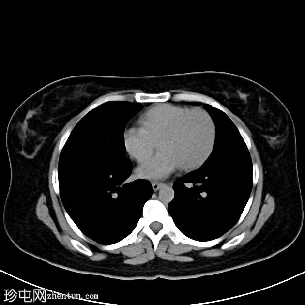 导管周围液体道（CT腹腔造影）