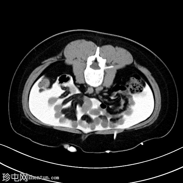 导管周围液体道（CT腹腔造影）