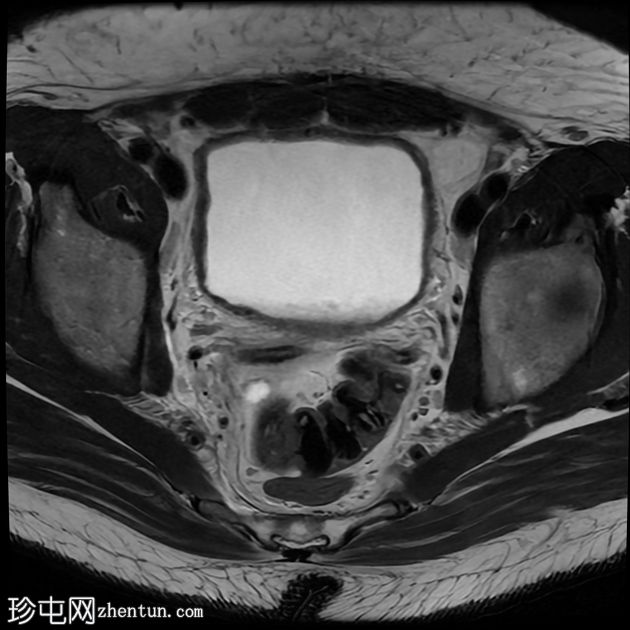 复杂性泌尿道感染和前列腺脓肿