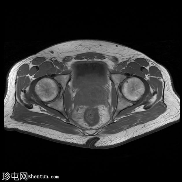 复杂性泌尿道感染和前列腺脓肿