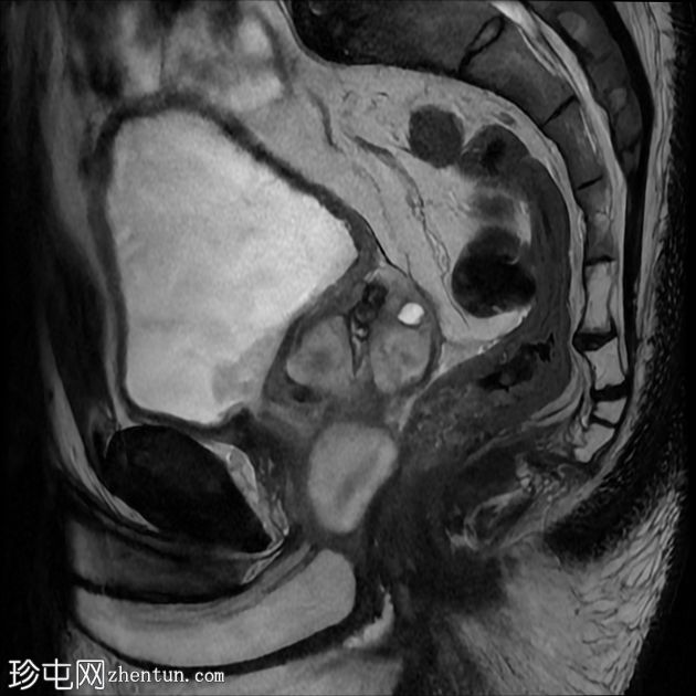 复杂性泌尿道感染和前列腺脓肿