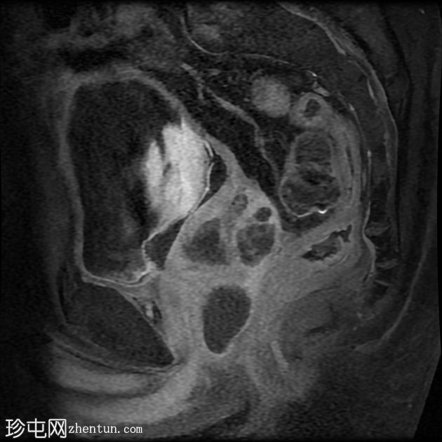 复杂性泌尿道感染和前列腺脓肿