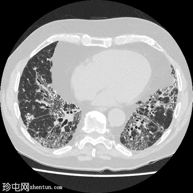 抗合成酶综合征