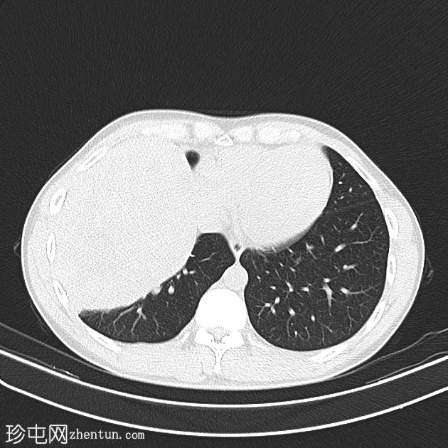 胸膜孤立性纤维瘤