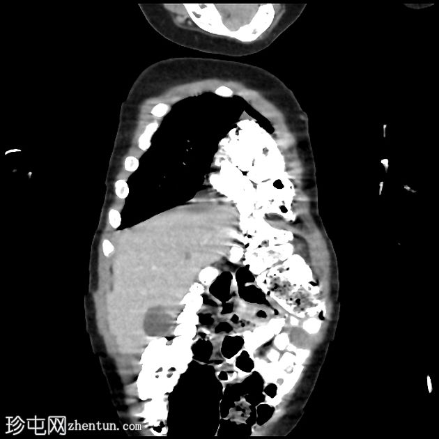 先天性膈疝