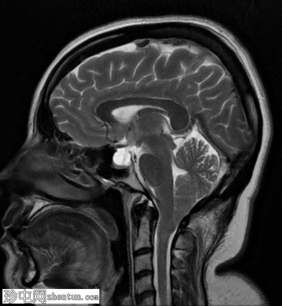 Chiari 1.5 畸形