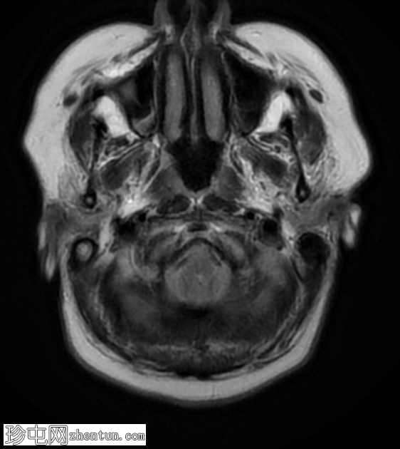 Chiari 1.5 畸形