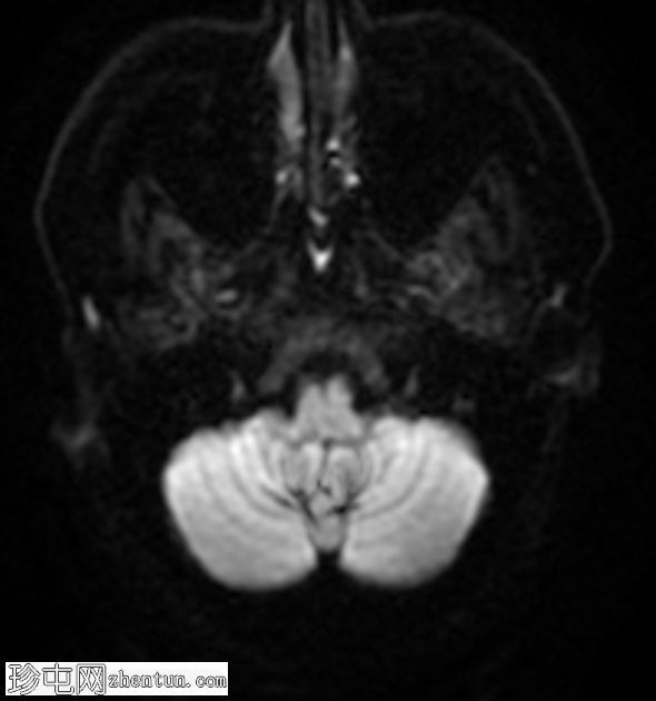 Chiari 1.5 畸形