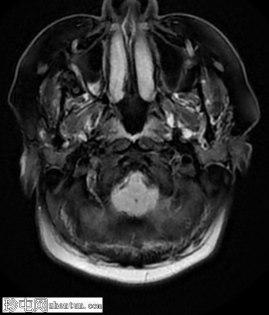 Chiari 1.5 畸形