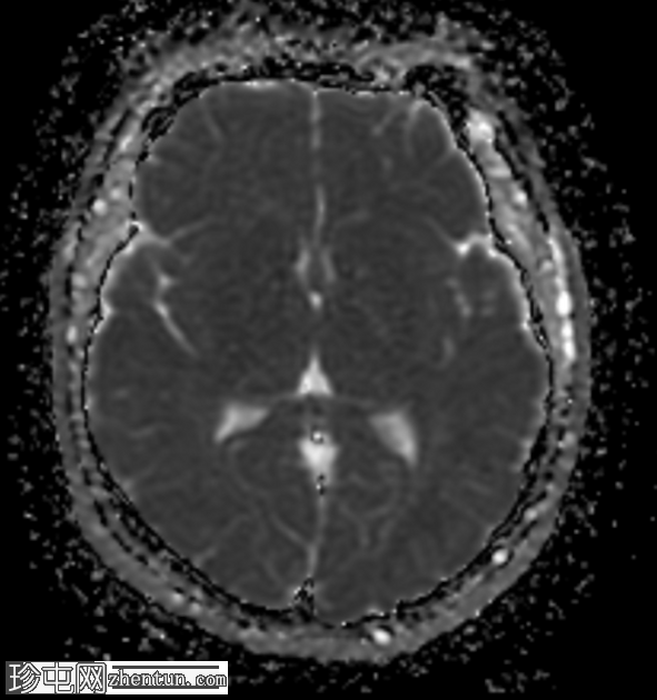 Chiari 1.5 畸形