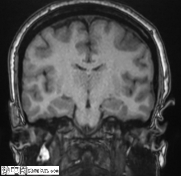 Chiari 1.5 畸形