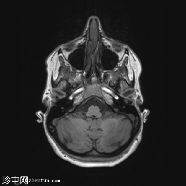 白质消失症（成人发病）