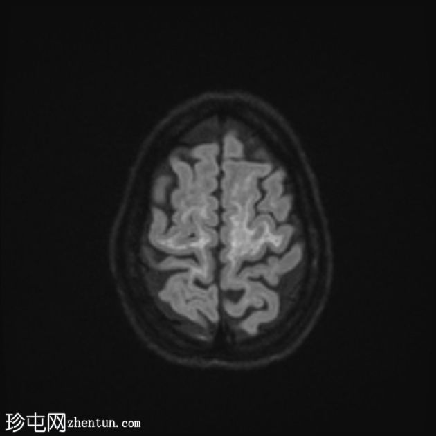 白质消失症（成人发病）