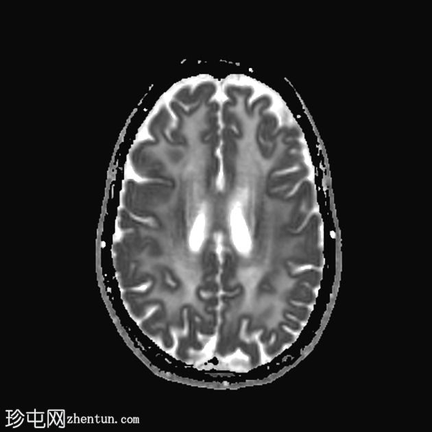 白质消失症（成人发病）