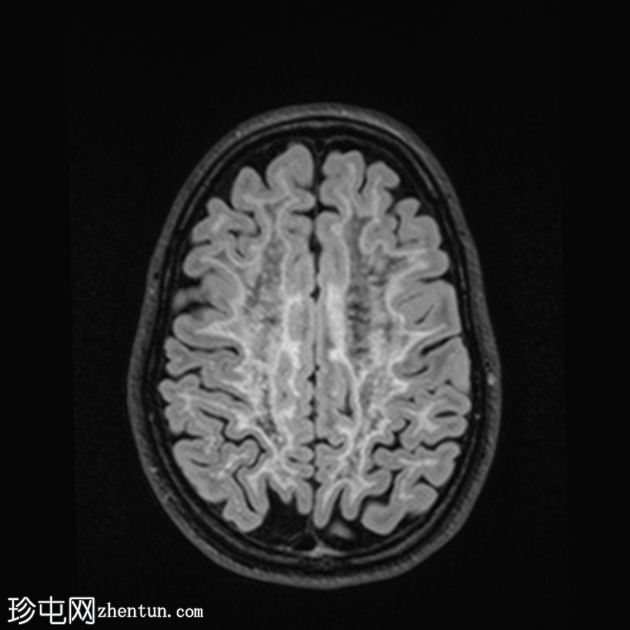 白质消失症（成人发病）