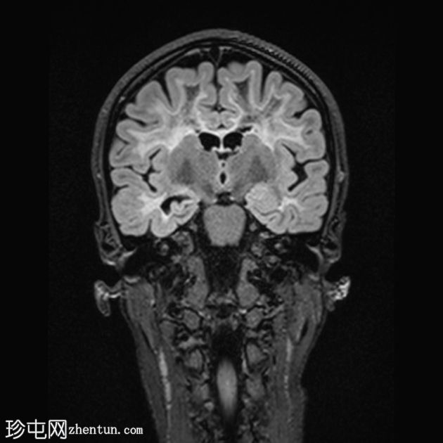 白质消失症（成人发病）