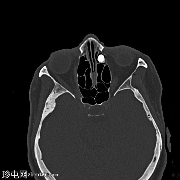 筛窦骨瘤