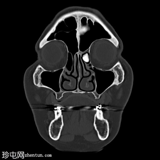 筛窦骨瘤