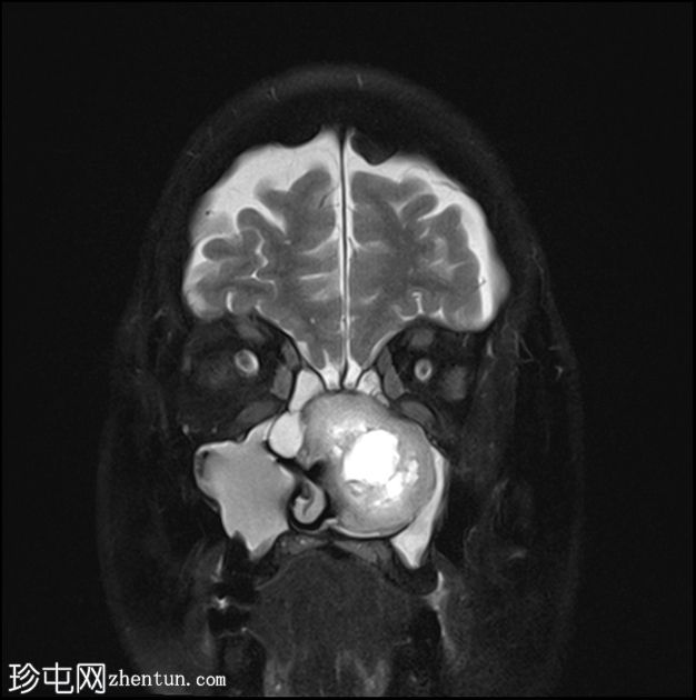 鼻窦软骨肉瘤