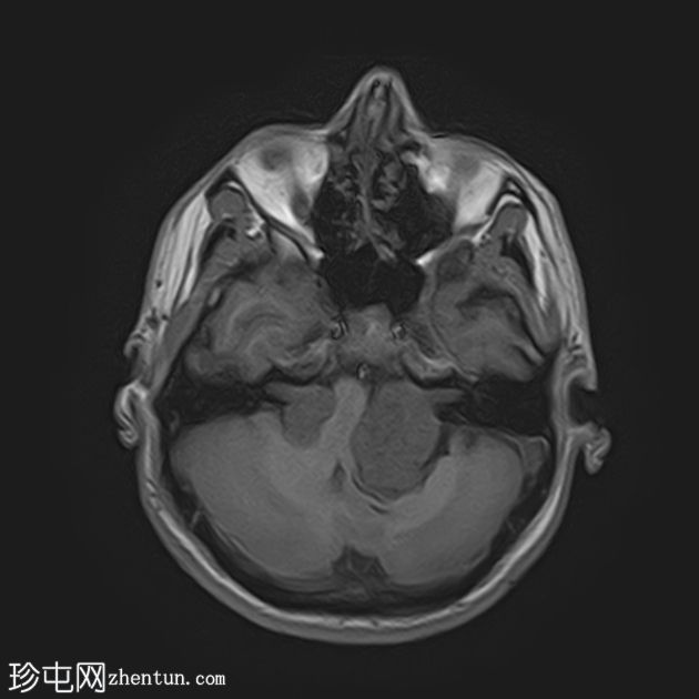 双侧前庭神经鞘瘤-神经纤维瘤病 2 型