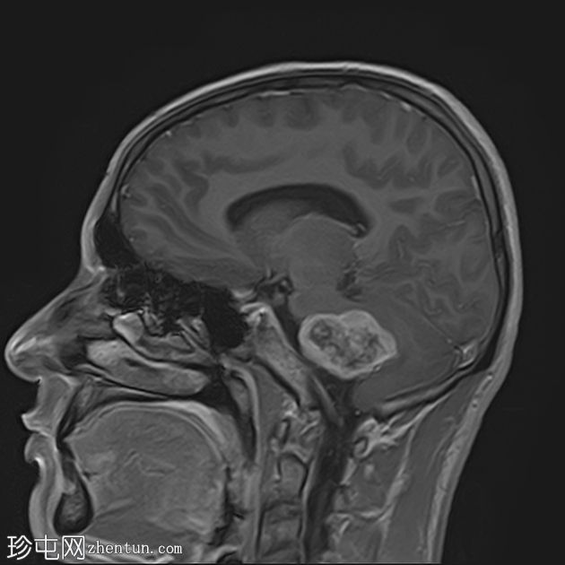 双侧前庭神经鞘瘤-神经纤维瘤病 2 型