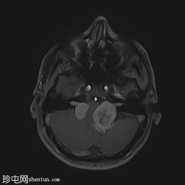 双侧前庭神经鞘瘤-神经纤维瘤病 2 型