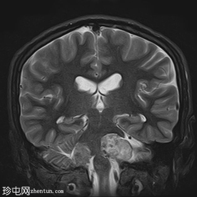 双侧前庭神经鞘瘤-神经纤维瘤病 2 型