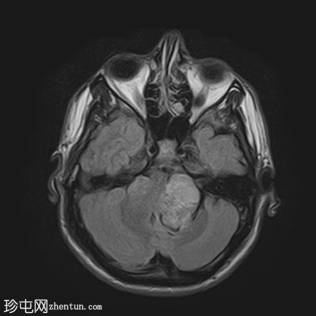 双侧前庭神经鞘瘤-神经纤维瘤病 2 型