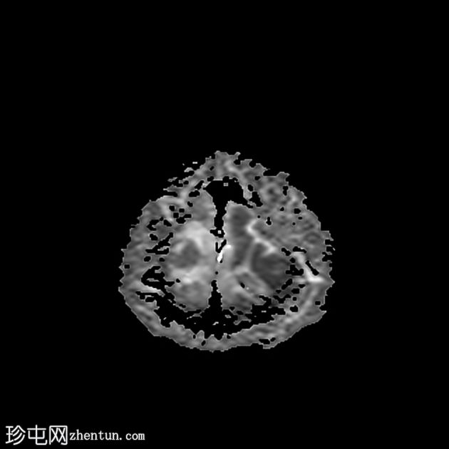 双侧前庭神经鞘瘤-神经纤维瘤病 2 型