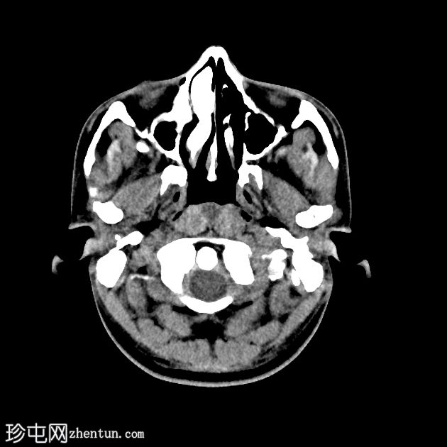 纤维发育不良-鼻腔