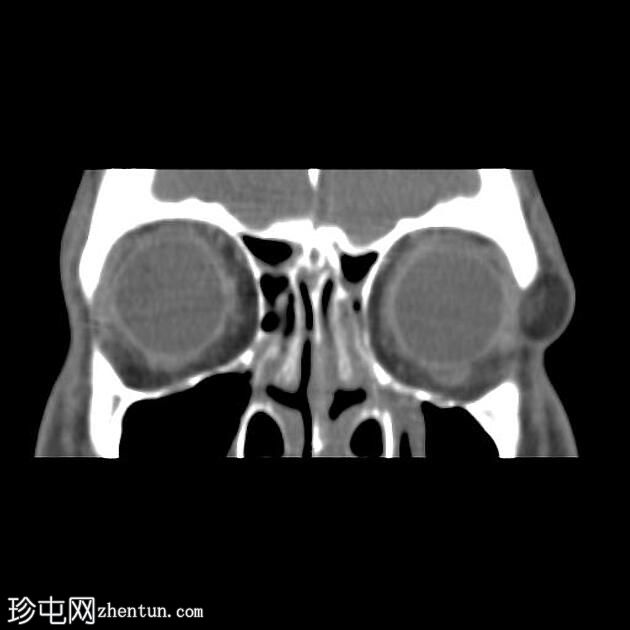 上眼睑皮样囊肿