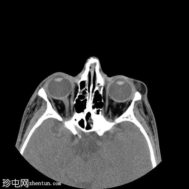 上眼睑皮样囊肿