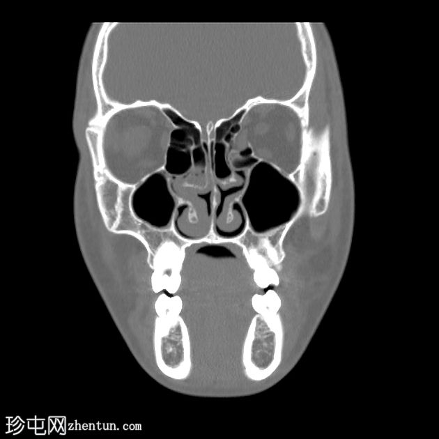 眶内壁爆裂性骨折伴有内直肌移位