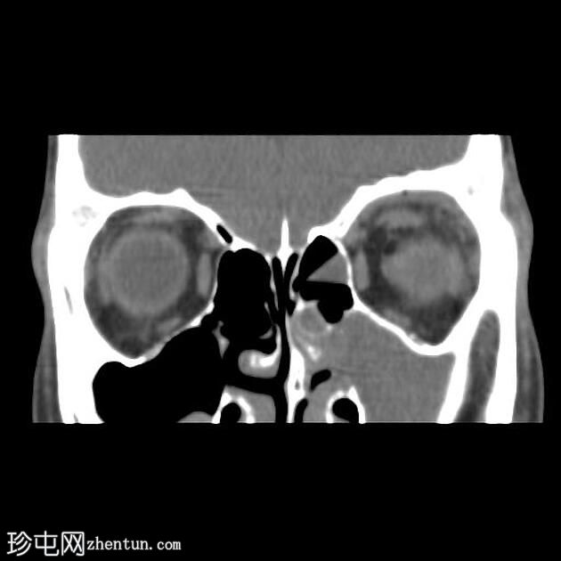 眶顶骨膜下采集