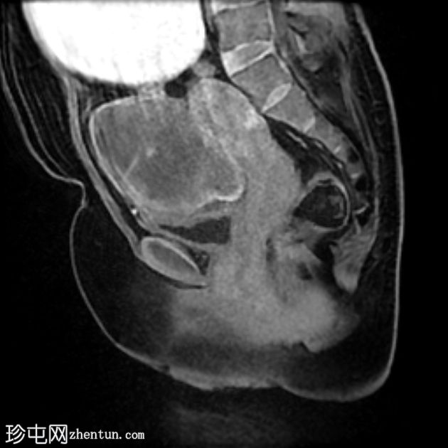 双侧卵巢扭转