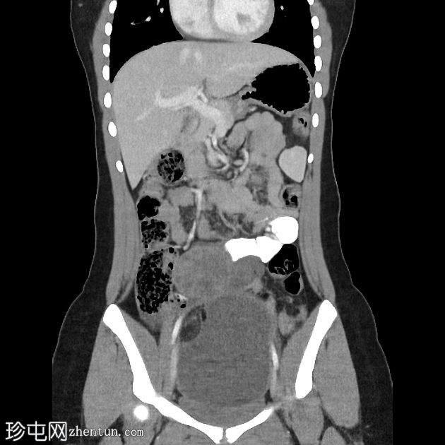 附件扭转