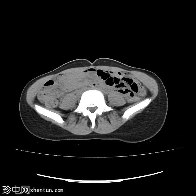 子宫出血性阴道炎