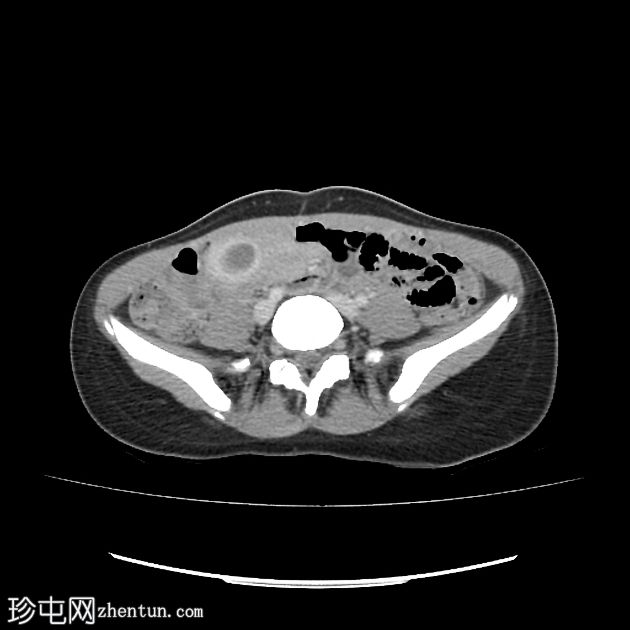 子宫出血性阴道炎