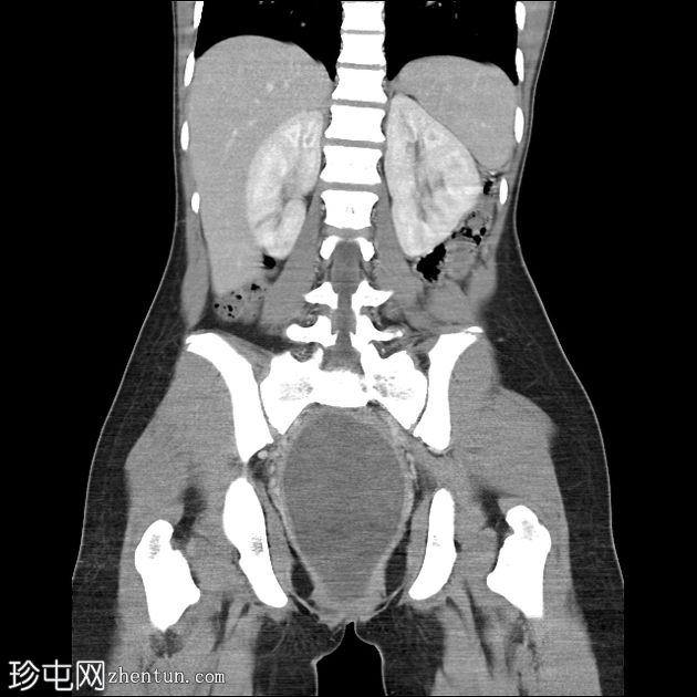 子宫出血性阴道炎