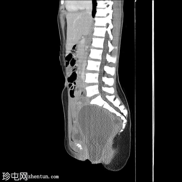 子宫出血性阴道炎