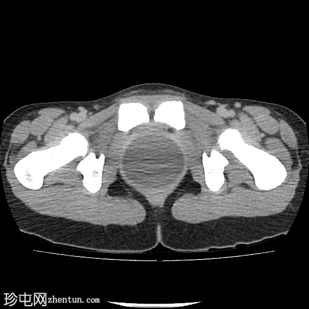 子宫出血性阴道炎