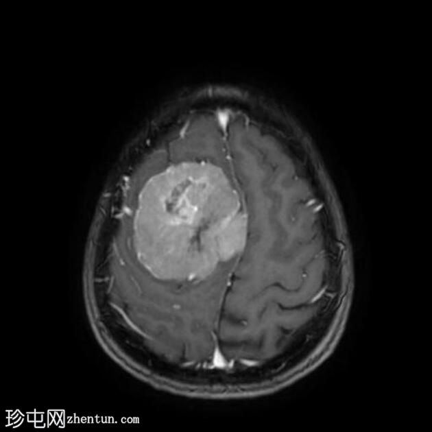 脑膜瘤 - 额叶