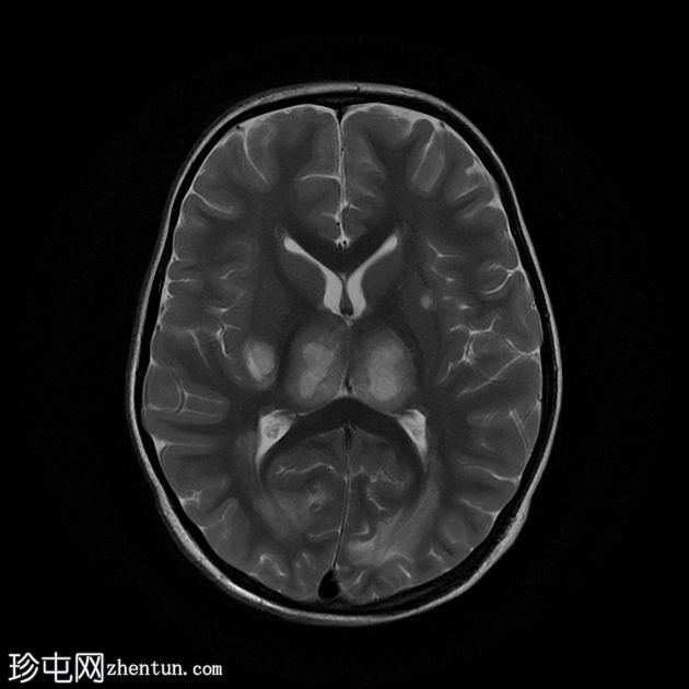 登革热脑炎