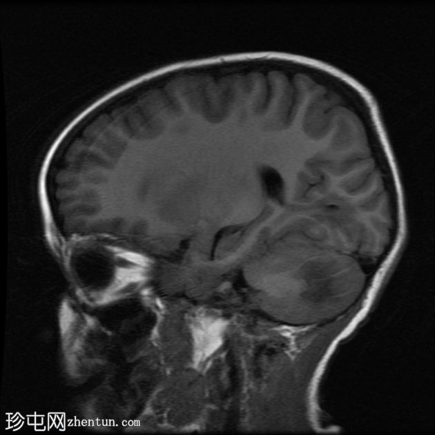 登革热脑炎