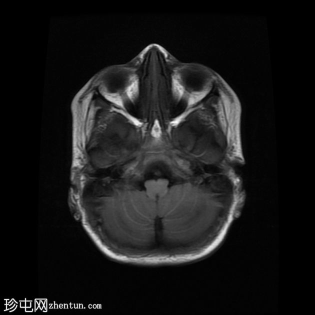 登革热脑炎