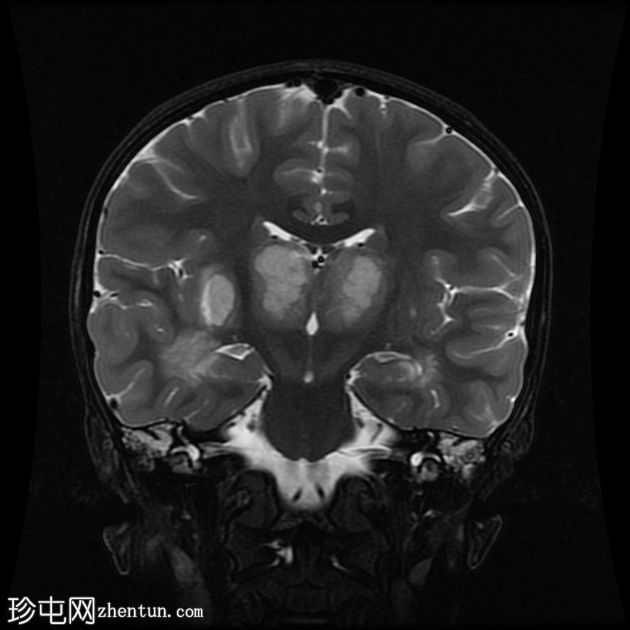 登革热脑炎