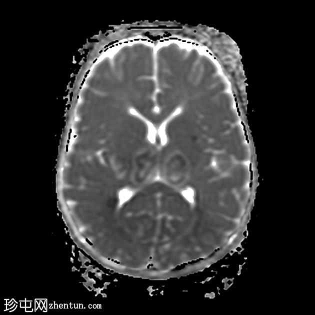 登革热脑炎