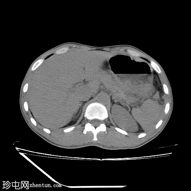 胰腺创伤