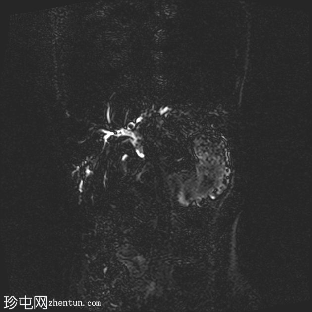 低磷脂相关胆结石综合征