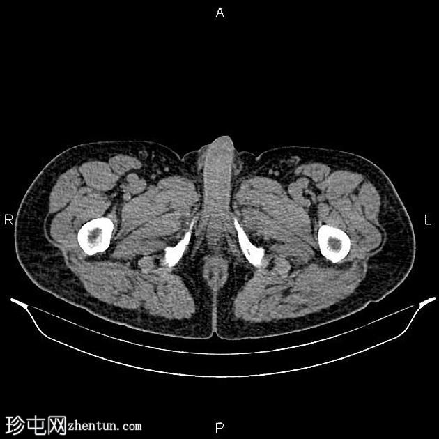 转移性胰腺导管腺癌